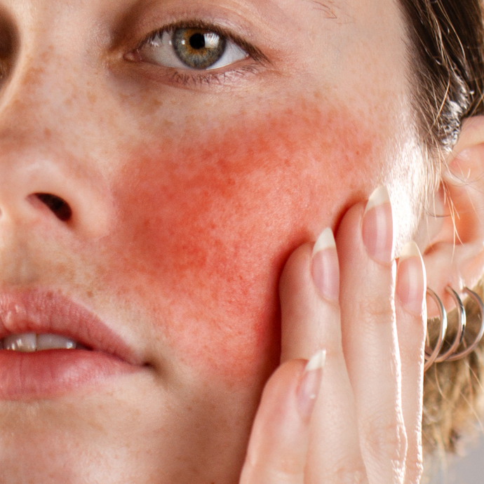 Natural Treatments for Rosacea