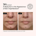 Before and after comparison of skin imperfections with a study result on a white background.