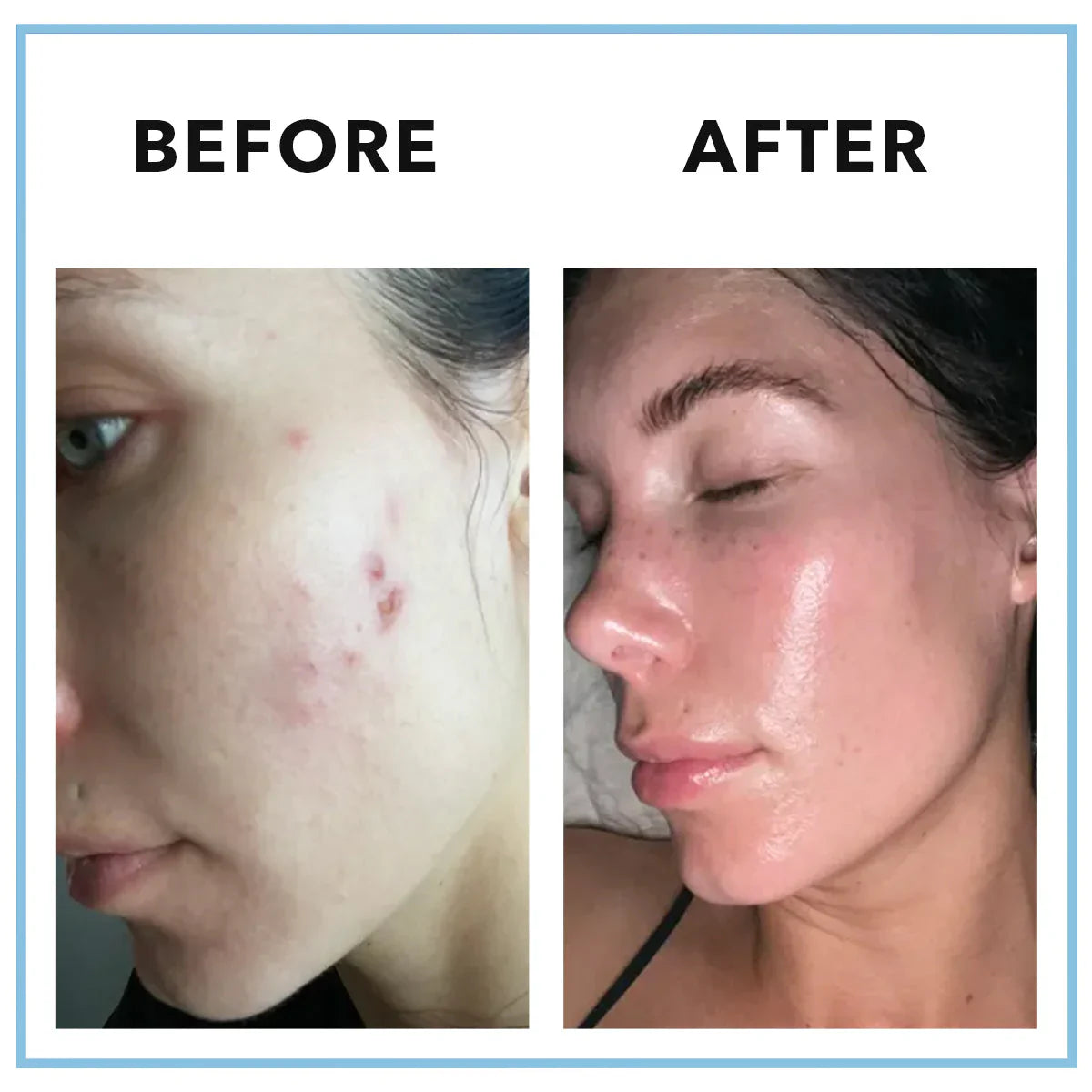 MINDBODYSKIN® - Hormonal Acne Supplement