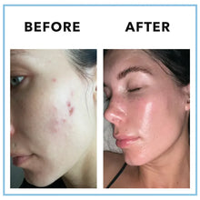 Load image into Gallery viewer, MINDBODYSKIN® - Hormonal Acne Supplement
