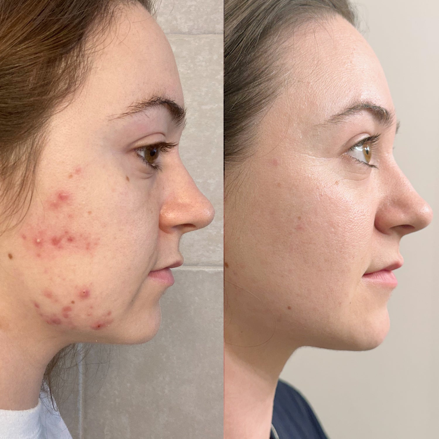 Oily and Acne Prone Skin